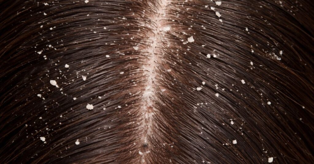 Herbal remedies for dandruff and causes of flaky scalp"